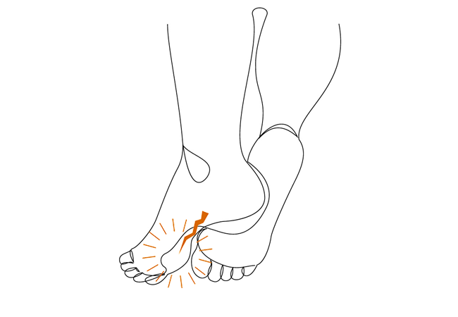 Einlagen bei Hohlfuß Orthopädische Einlagen können den Fuß stabilisieren