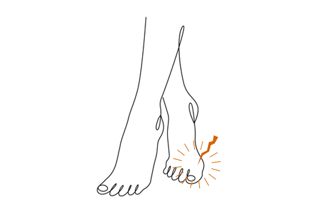 Einlagen bei Hallux rigidus Hallux valgus und Hallux rigidus sind die häufigsten Funktionsstörungen der Großzehe.