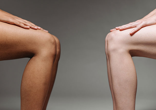 X- und O-Beine sind oft auf Kniefehlstellungen zurückzuführen